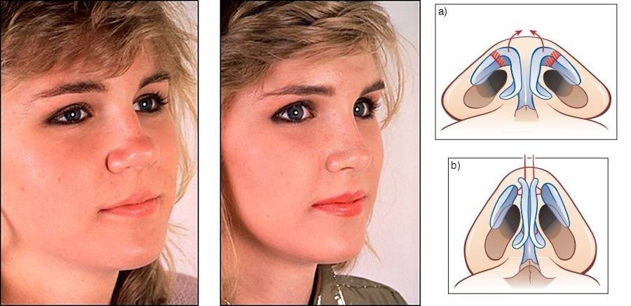 Ринопластика широких носов. Ринопластика широкого кончика носа. Ринопластика сужение носа.