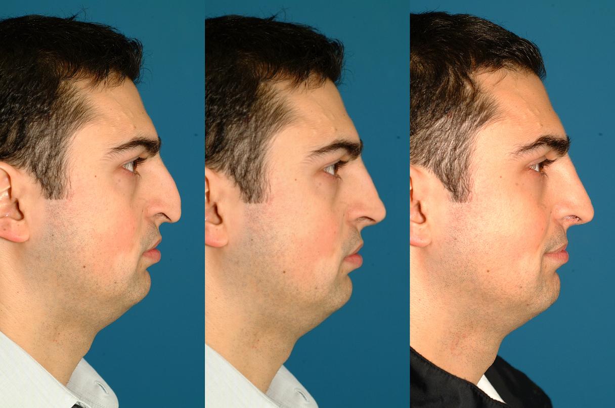 Ринопластика больших носов. Ринопластика горбинки носа. Ринопластика до и после мужчины. Исправление горбатого носа.